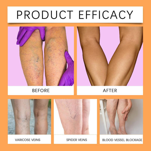 Varicose Veins Care Spray - Buy 1 Get 2 Free