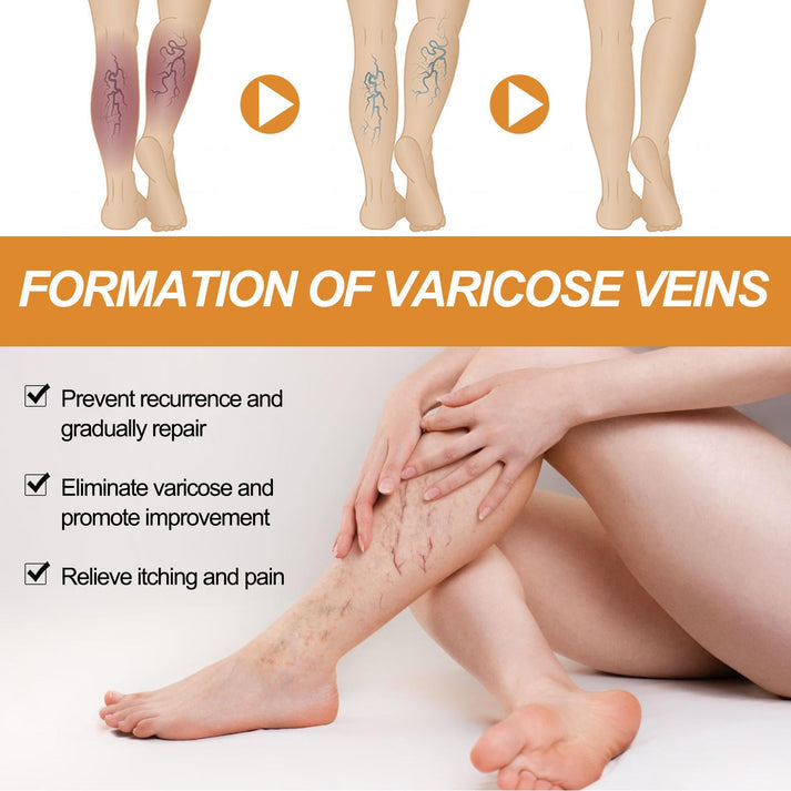 Varicose Veins Care Spray - Buy 1 Get 2 Free