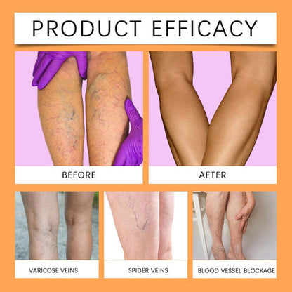 Varicose Veins Care Spray - Buy 1 Get 2 Free