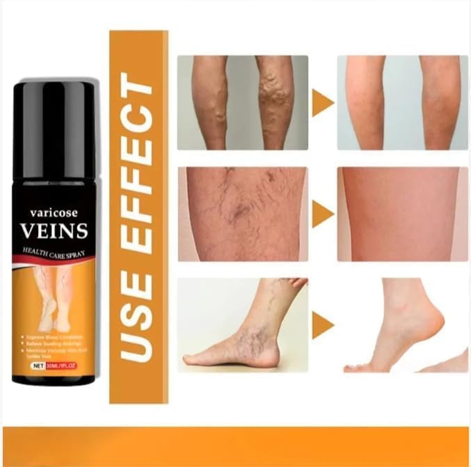 Varicose Veins Spray (Buy 1 Get 1 Offer)