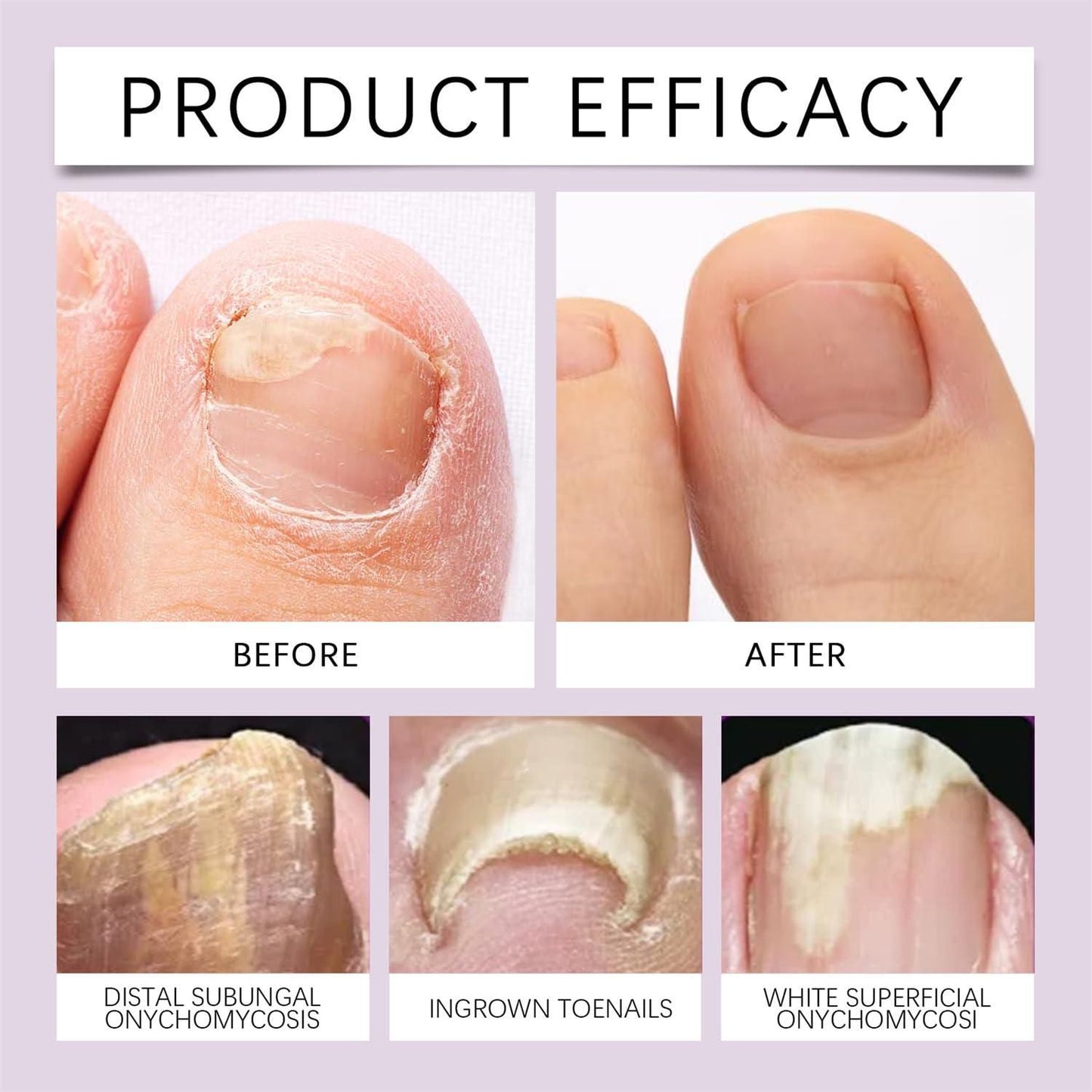 NailRevive - Nail Growth & Repair serum(Buy 1 Get 1 FREE)