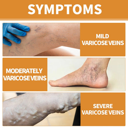 Varicose Veins Care Spray - Buy 1 Get 2 Free